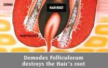 demodex tönkreteszi a hajhagymákat